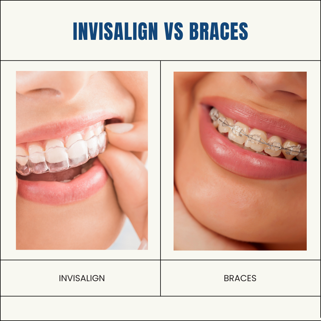 Invisalign Consultation