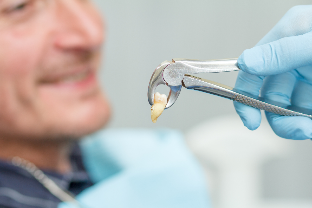 Best Dentist in Calgary for tooth extraction