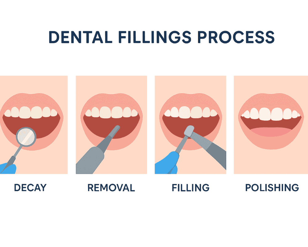 Dental Fillings Process