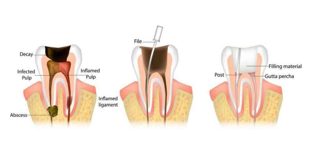 Root Canal Procedure