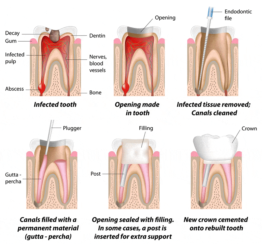 Root Canal in Calgary