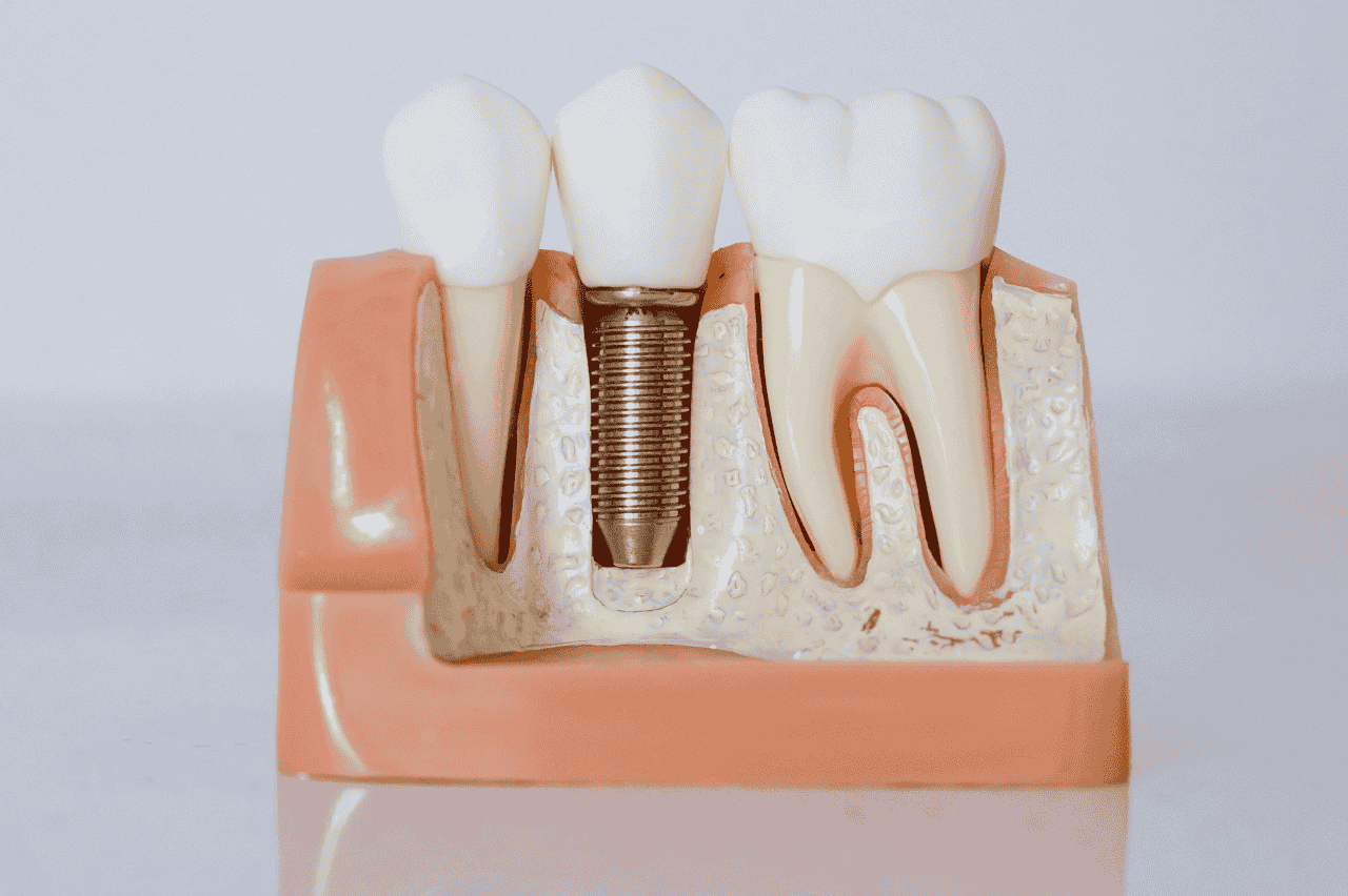 Best Dentures in Calgary