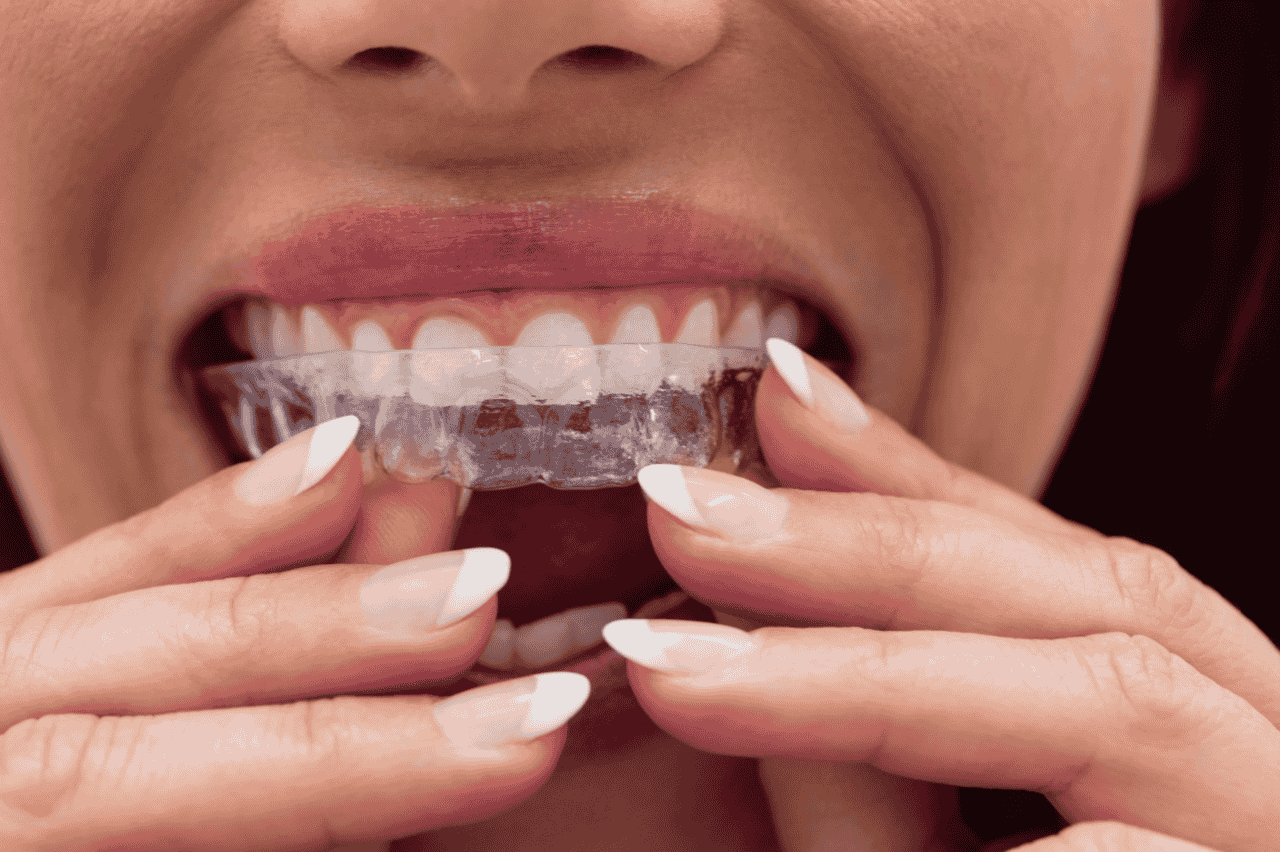 How Invisalign Works​