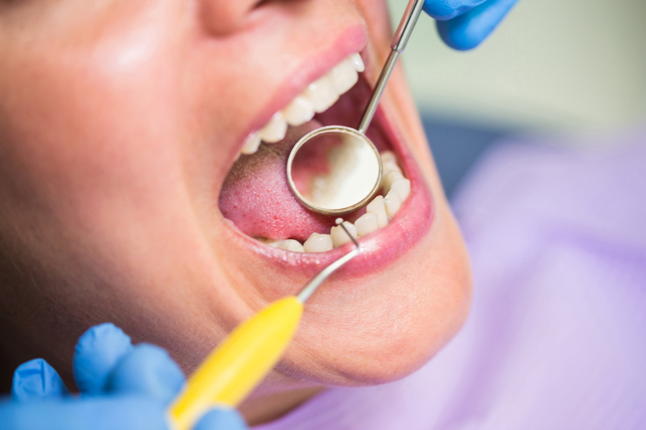 Why Emergency Root Canals Are Common in Canada